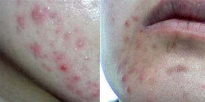 下巴兩側長痘痘是什麼原因 可能是內分泌失調