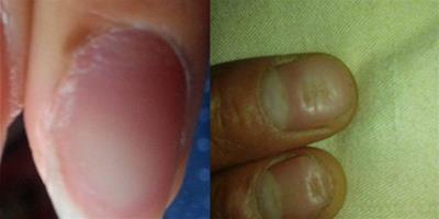 為什麼手指甲凹凸不平有橫溝 說明你的身體出現問題