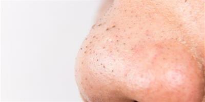 鼻子黑頭怎麼根治 四招護膚技巧讓你恢復光滑皮膚