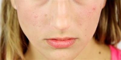 鼻頭發紅怎麼辦 分清楚原因及時治療