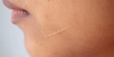 怎麼消疤痕更有效 輕鬆四招助你擁有水嫩皮膚