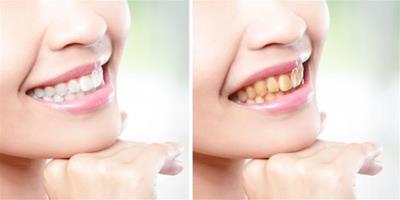 黃牙變白的簡單方法 掌握這幾招就能夠擁有潔白牙齒