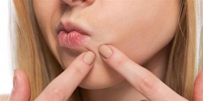 嘴角長痘是什么原因 這五種情況需要注意