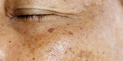 皮膚長斑的原因和調理方法 長斑或與這幾個因素有關