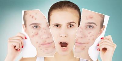 臉上長痤瘡是什么原因 為什么臉上容易長痘