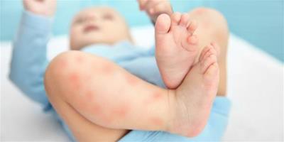 寶寶臉上有濕疹能擦甘油嗎 對嬰兒有沒有副作用