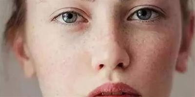女性長黃褐斑是什麼原因 黃褐斑的消除方法
