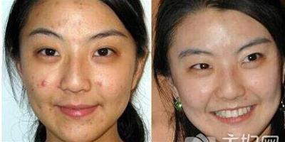 女人的皮膚最怕長斑 自製2款祛斑面膜效果心得分享