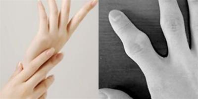 手指關節變粗怎麼復原 5個方法教會你