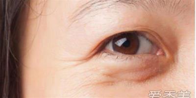 眼袋大是什么原因造成的 促進眼袋形成的5類特征