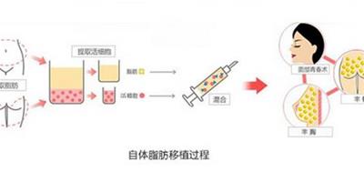 自體脂肪豐臀效果好嗎