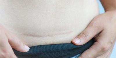 剖腹產后怎樣減肥 推薦這四種方法