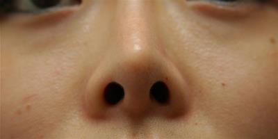 隆鼻手術會影響月經嗎 隆鼻手術有沒有后遺癥
