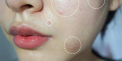 坑坑痘痘影響顏值丨究竟臉上毛孔粗大怎么改善？