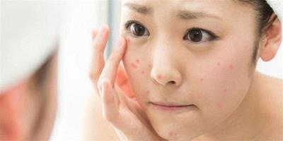 痤瘡時，您需要注意這些事項，以盡量減少對皮膚的影響