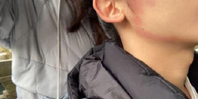 護膚攻略：用甲硝唑凝膠祛痘應對口罩臉過敏現象可行嗎？
