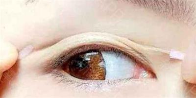 雙眼皮貼可以貼多久 ​雙眼皮貼可以過夜嗎