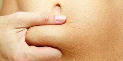 腹部肥胖怎么減 肥胖紋能去除嗎