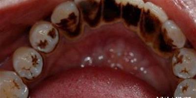 有牙結石怎麼自己清潔？ 牙結石的治療與防護
