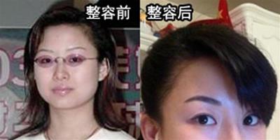 九球天后潘曉婷 整容前後對比照