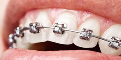 整牙的好處有哪些 詳細介紹矯牙的注意事項