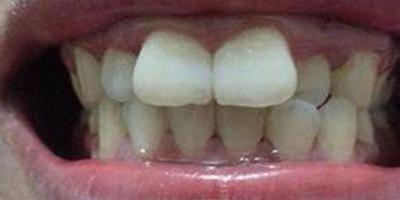 牙槽突出應該怎麼辦？ 小編教你3個簡單方法
