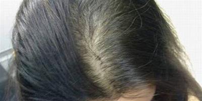 脂溢性脫髮偏方大全 醫學專家詳細分析脫髮幾大病因