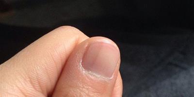 手指上有黑色豎紋是怎麼回事？ 如何根據指甲自測健康