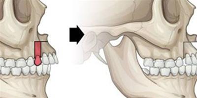 女生上顎骨突出怎麼矯正 兩大秘訣讓你不再做凸嘴女人