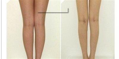 小腿吸脂的副作用有哪些 小腿吸脂術後護理工作