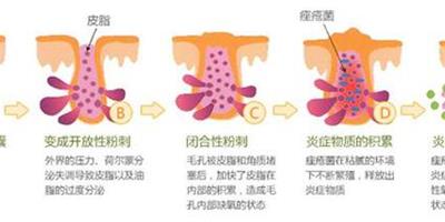 粉刺怎麼去除？粉刺和痘痘的區別