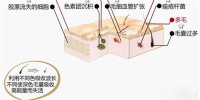 鐳射脫毛有哪些傷害 10大問題為你解答鐳射脫毛的疑問