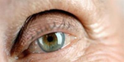 老年眼皮下垂 是病還是正常的生理現象