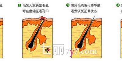 怎麼用水楊酸改善雞皮膚 去角質是關鍵