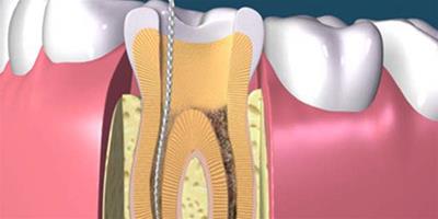 牙齒根管治療過程展示 瞭解根管治療後疼痛的原因