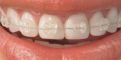 牙齒保持器注意事項有哪些？ 專家告訴你如何維護好牙齒