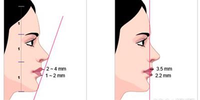 隆下巴恢復期是多少 一招教你如何保養好