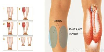 打瘦腿針過程圖 詳解注射瘦腿針的全過程