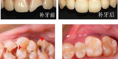 揭秘補牙疼嗎 可能造成補牙時疼的原因曝光