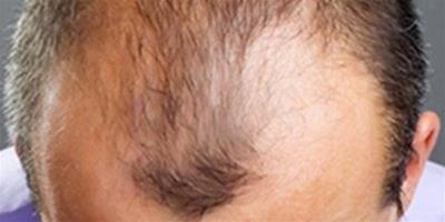 治脂溢性脫髮方法有哪些 7大方法讓你擺脫脫髮煩惱