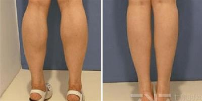 瘦腿針可以維持多久 瘦腿針的不是永久的你知道嗎