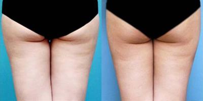 大腿環形抽脂減肥 抽脂的各大注意事項必知