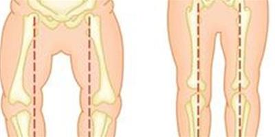 分析膝蓋內翻怎麼矯正 讓你擺脫o型腿