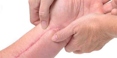 凹陷疤痕修復術介紹 4種治療方法還你健康皮膚