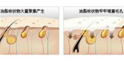 不要輕視黑頭小心變成草莓鼻，教你如何擺脫草莓公主