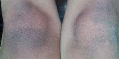膝蓋黑如何修煉白嫩玉腿？ 推薦9個膝蓋保養方法