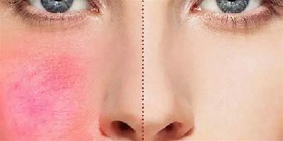 楊紫曬照滿臉紅痕 臉上長蕁麻疹怎麼護理？