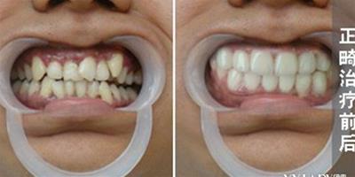 正畸牙齒對比圖 正畸治療的最佳時機是什麼時候
