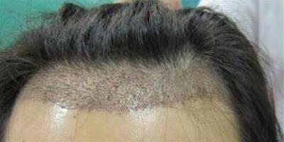 治療脫髮的最佳方法 6個方法教你輕鬆治療脫髮