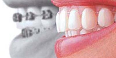 牙齒矯正牙齒中間有縫怎麼辦 須知的矯正牙齒注意事項